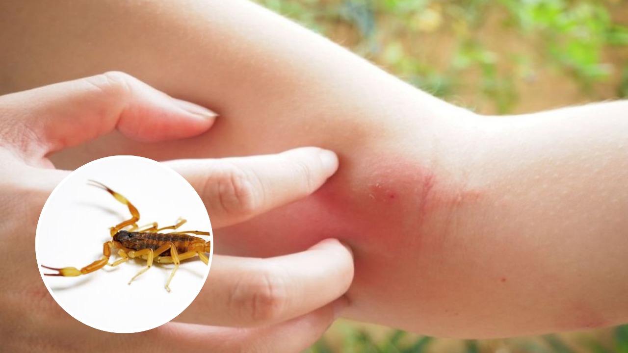 A person touching a red, swollen area on their arm, indicating a reaction to a scorpion sting, with a scorpion image in the corner.$#$ CAPTION