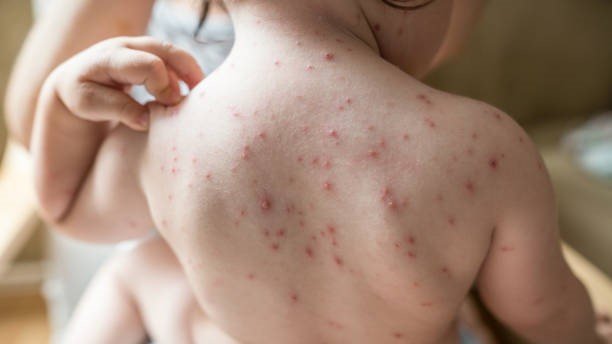 A close-up of a child's back showing red spots, likely indicating a skin condition or irritation.$# CAPTION
