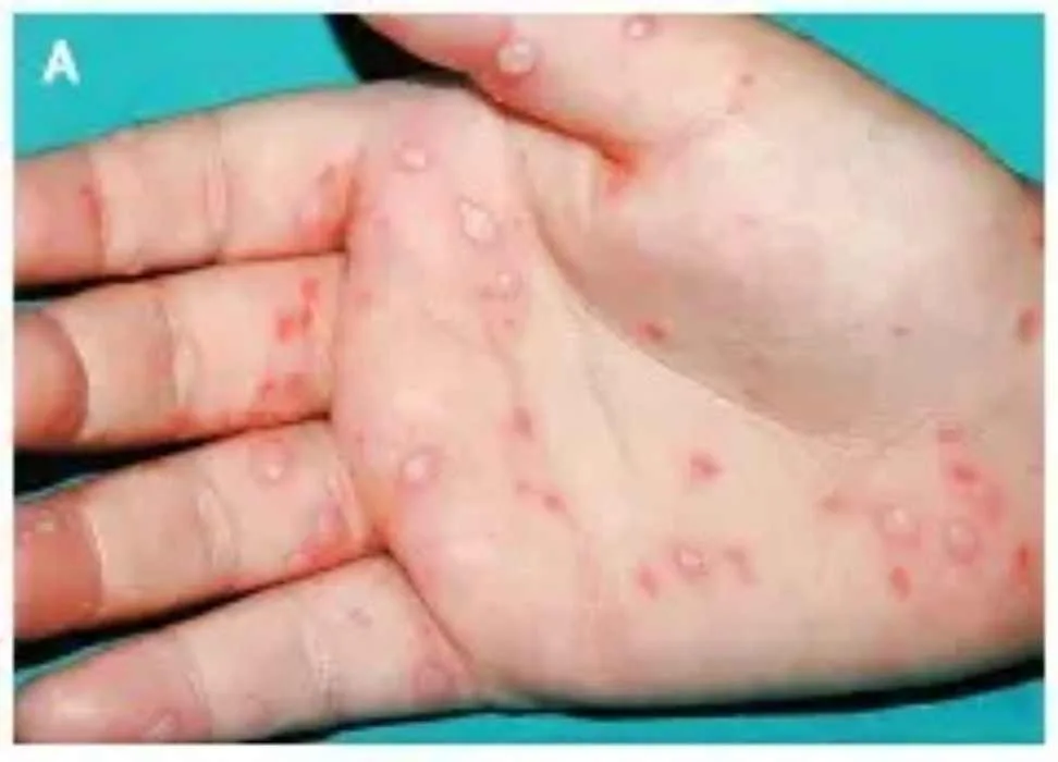 A close-up image showing the palm of a hand with numerous small, raised red lesions on the skin. The background is a solid color.