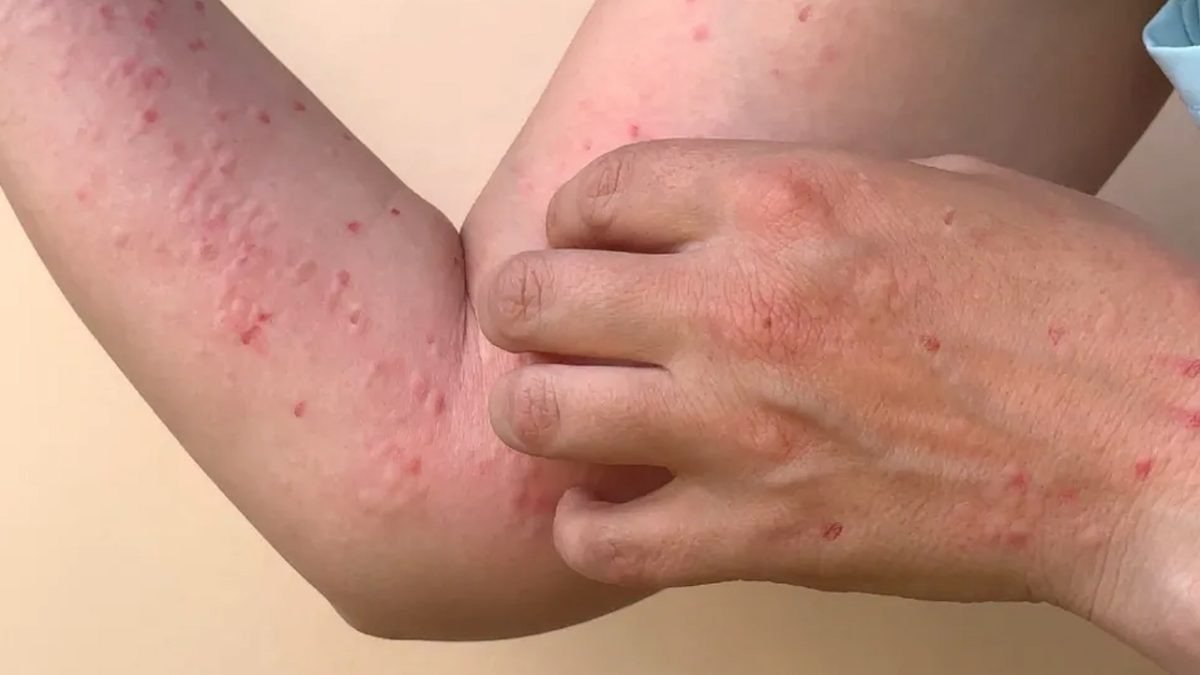 Health officials monitoring monkeypox cases in Quintana Roo