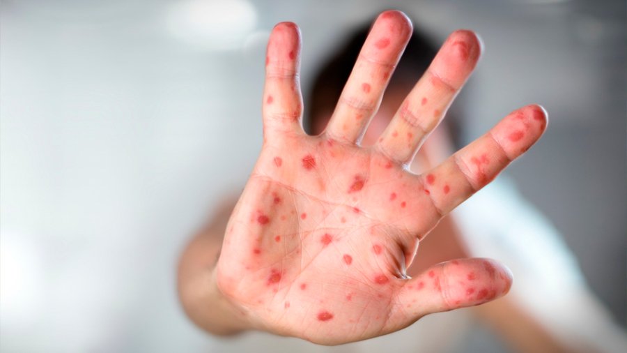 Illustration or photo related to measles outbreak in Mexico
