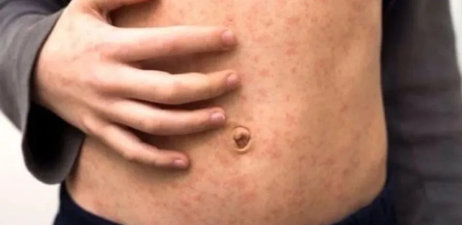 Health officials discuss measles outbreak response in Mexico