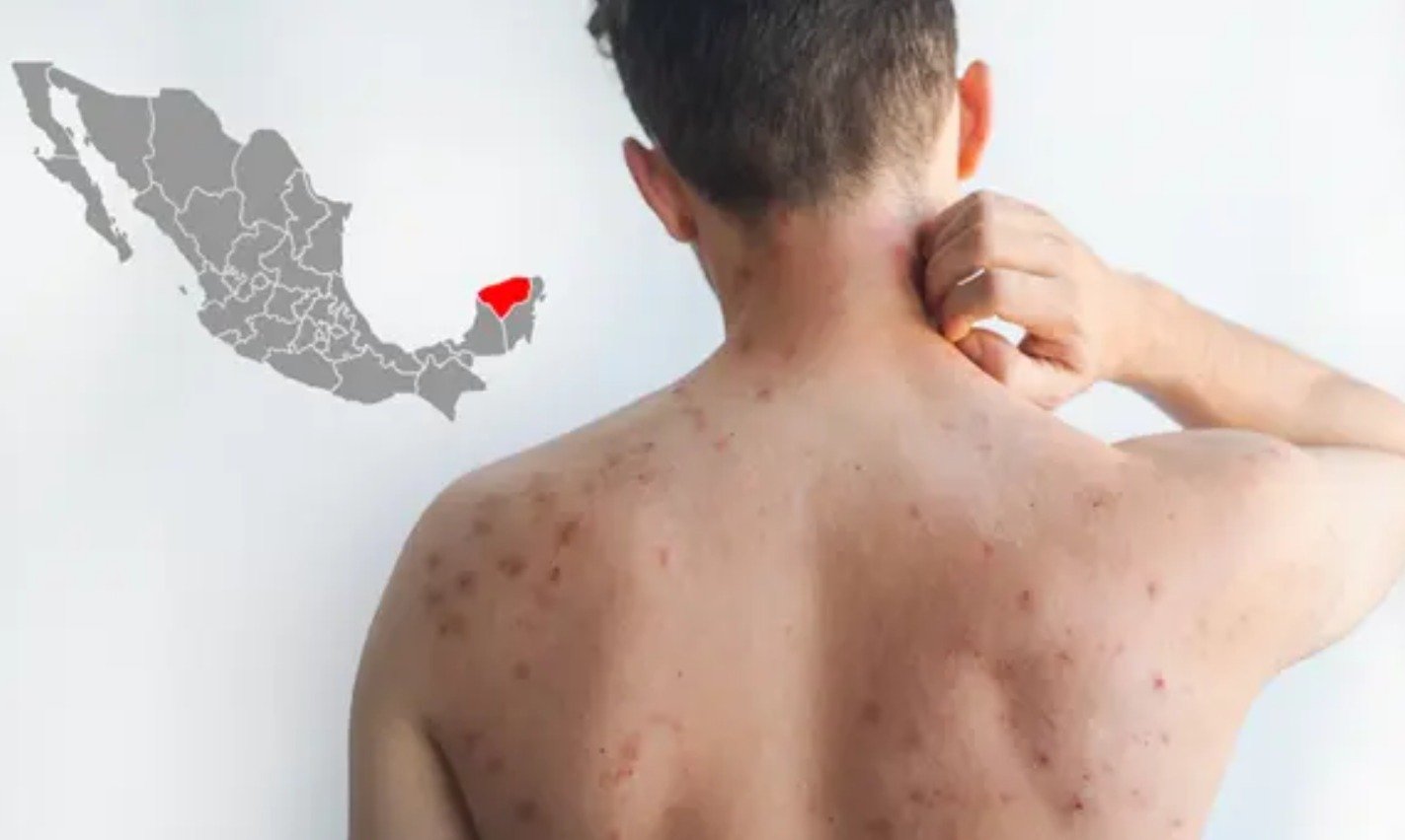 A person scratching their neck with visible skin condition on their back; a map of Mexico in the corner highlighting a region in red. $#$ CAPTION