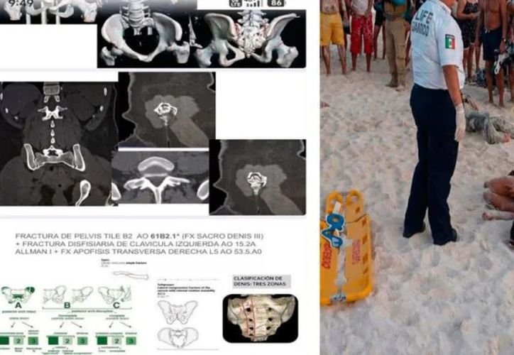 A woman lies in a hospital bed after being hit by a jet ski in Cancun