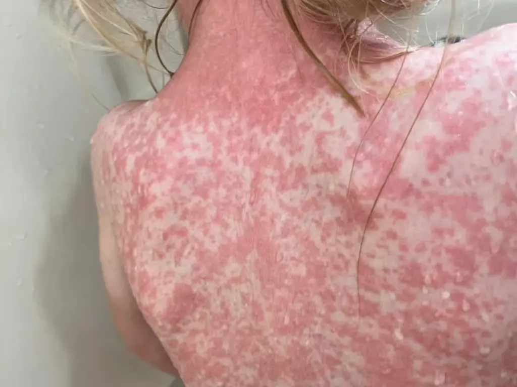 A graph showing the daily incidence of measles cases in Quintana Roo, Mexico, in 2026.