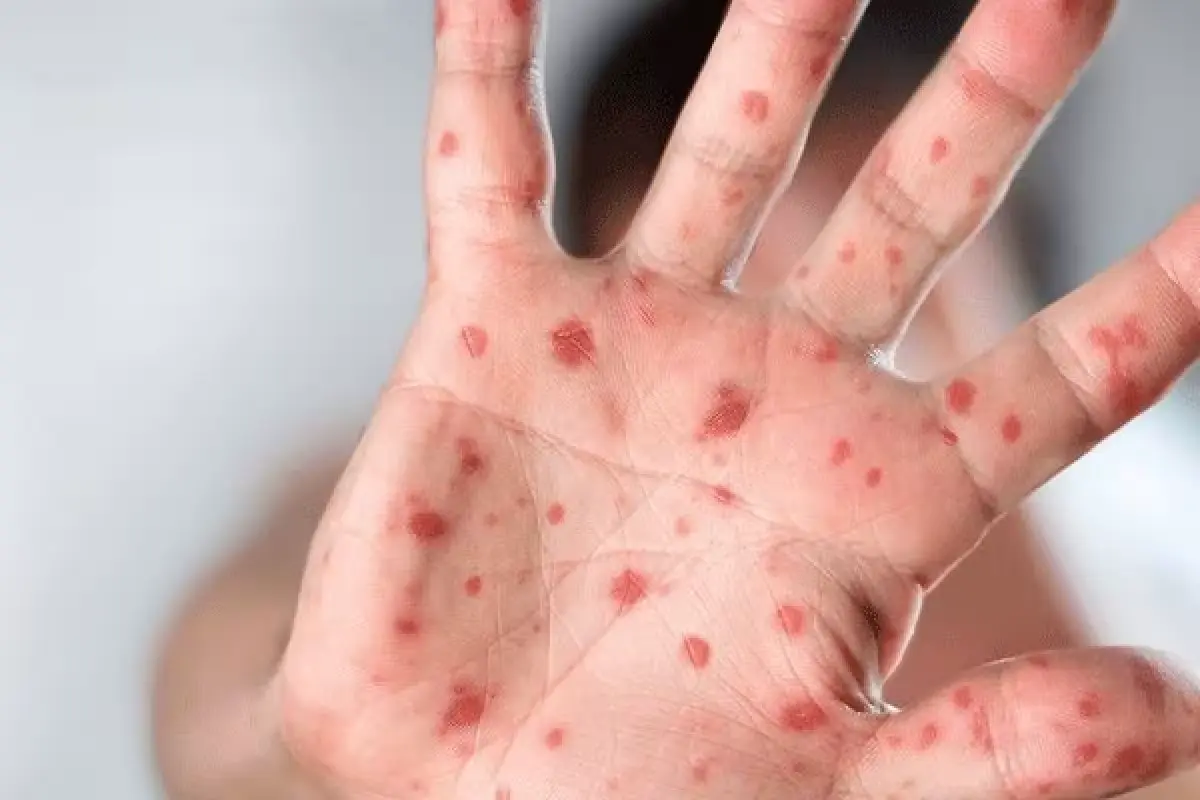 Illustration of mpox virus particles