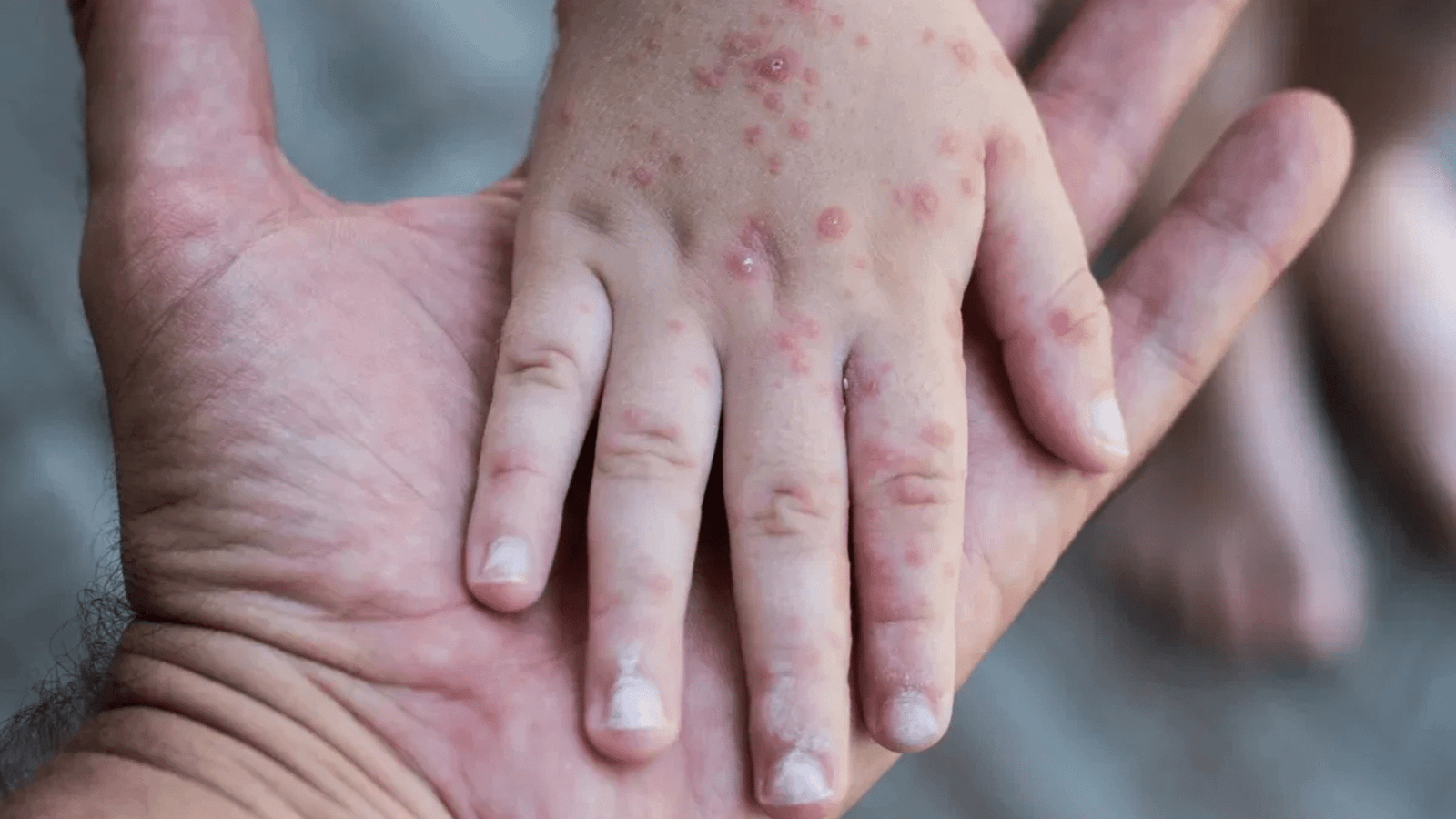 Illustration of measles virus particles representing the outbreak across Mexico's Yucatan Peninsula, where cases rose nearly 1,940 percent